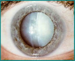 cataract12.jpg